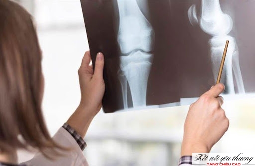 Chụp X-quang sụn khớp có thể trả lời câu hỏi bạn còn có khả năng cao thêm không