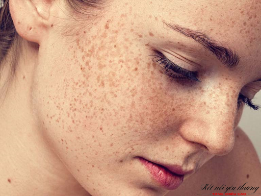 Lý do những đốm nâu tàn nhang xuất hiện dày đặc khắp trên khuôn mặt?